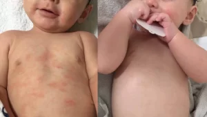 Bệnh chàm có phải do nước cứng gây ra?