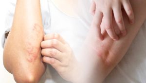 Thiết bị làm mềm nước có thể chữa khỏi bệnh chàm không?